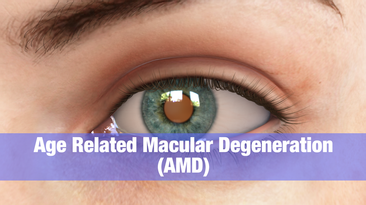 AGE RELATED MACULAR DEGENERATION (ARMD)