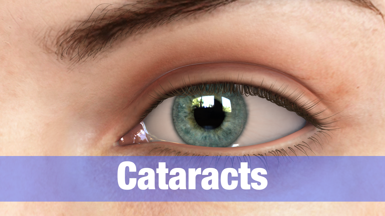 CATARACTS