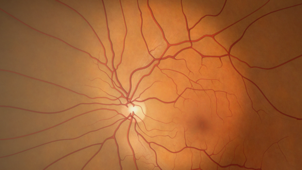 RETINAL CONDITIONS