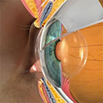 Intraocular Lens